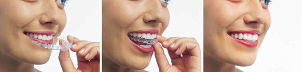 Clear Aligner Therapy